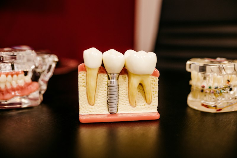 Zobu implants, griezuma modelis